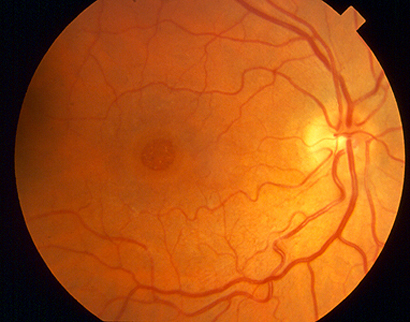 retina vitreous consultants