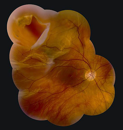 Retinal Tear and Retinal Detachment - Retina Consultants